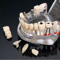 Dental Implant Pathological  Model with Restoration & Bridge tooth