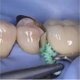 Dental Adaptive Wedge