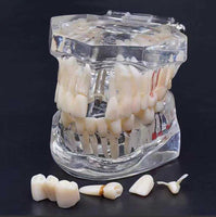 Dental Implant Pathological  Model with Restoration & Bridge tooth