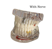 Dental Implant Pathological Model with Nerve