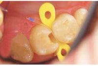 Dental Interdental wedge