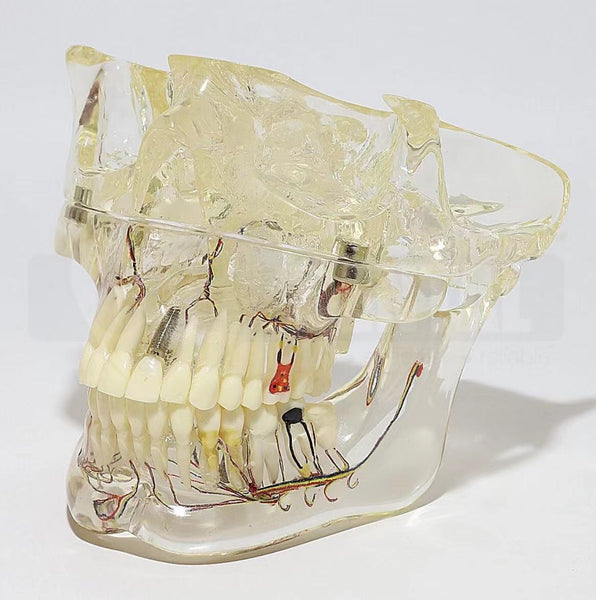 Solid Transparent Pathological Model Full Jaw with Nerve inc Sinus
