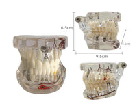 Dental Implant Pathological Model with Nerve