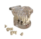 Dental Implant Pathological Model with Nerve